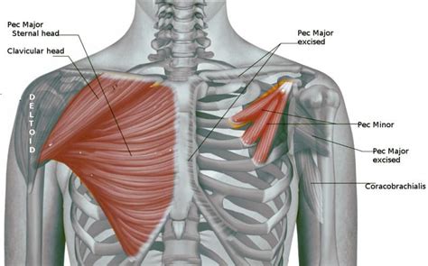 The Pectoralis Minor Being Affected By Myofascial Pain - Integrative ...