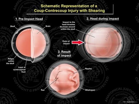 Schematic Representation of a Coup - Contrecoup Injury with Shearing