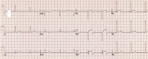 Wellens Syndrome • LITFL • ECG Library Eponym