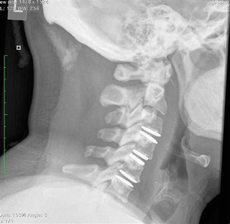 Cervical Arthroplasty | IntechOpen