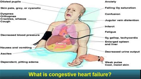 Congestive Heart Failure - congestive heart failure - Explained - MADE EASY end of life - YouTube