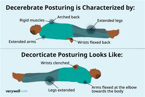 Decerebrate Posturing: Brain Injury, Effects, Survival