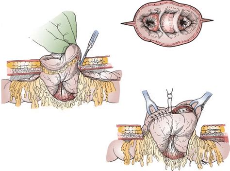 Loop Ileostomy Closure