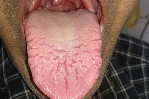 Fabulous Info About How To Cure Fissured Tongue - Grantresistance