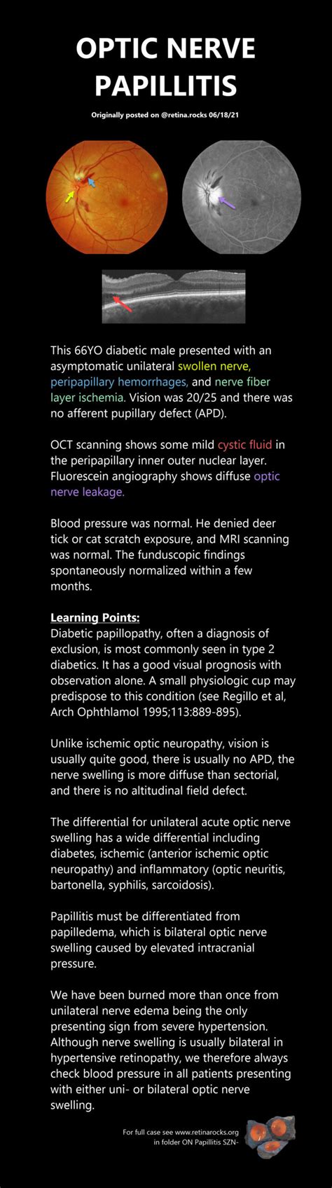 Optic Nerve Disorders > Papillitis - Retina Rocks