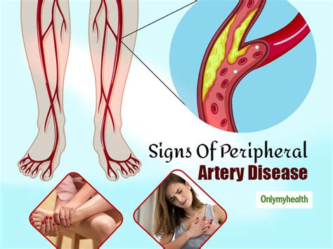 Peripheral Artery Disease: Acute Pain In Chest And Leg Are Signs of PAD ...