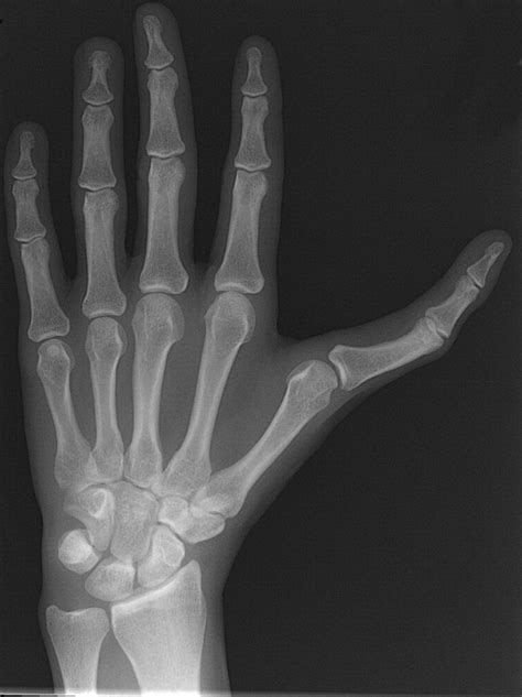 Evaluation of Function and Appearance of Adults With Untreated Triphalangeal Thumbs - Journal of ...