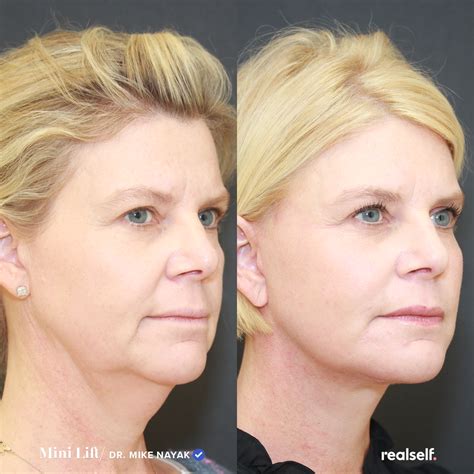 Mini Facelift vs. Full Facelift: What’s the Difference? | Sagging skin ...