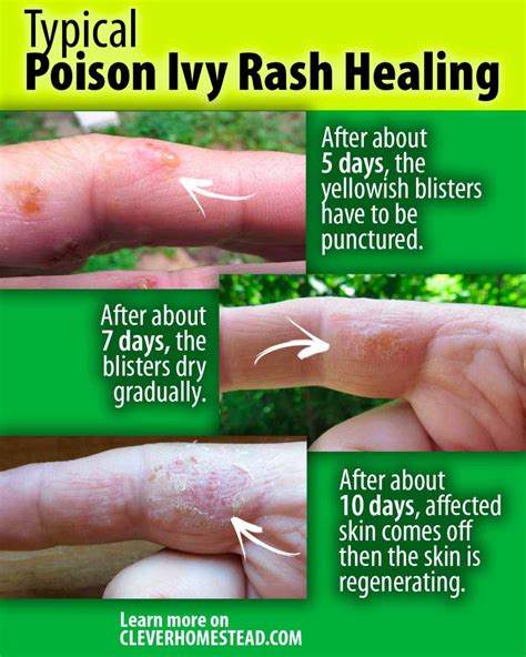 Poison ivy, poison oak and poison sumac RELIEF, TREATMENT and HEALING ...