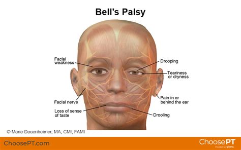 bell palsy treatment exercises (pdf) - Jani Rosenthal