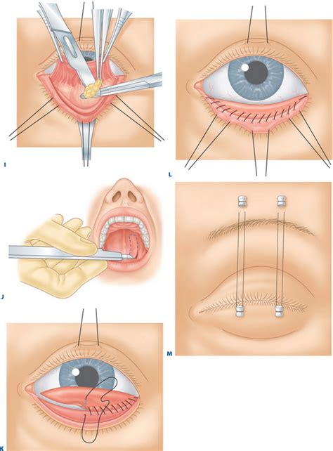 Treatment of Lower Eyelid Retraction with Recession of Lower Lid Retractors and Placement of ...