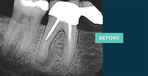 Root Canal - Before & Afters | Midtown Endodontist NYC