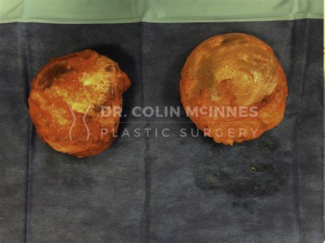 Breast Implant Removal & Capsulectomy | Dr. Colin McInnes