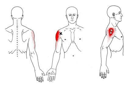 Deltamuskel | The Trigger Point & Referred Pain Guide Hand Therapy ...