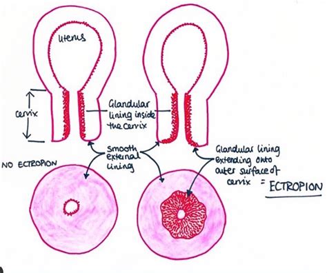 Ectropion