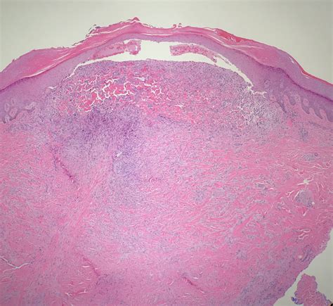 Dermatofibroma Histology