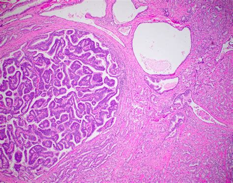 Prostate Adenocarcinoma Histology