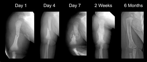 Proximal Humerus Fracture Cast