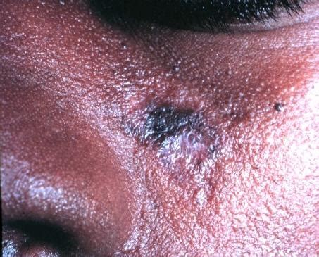 Discoid lupus: Symptoms, causes, and treatment