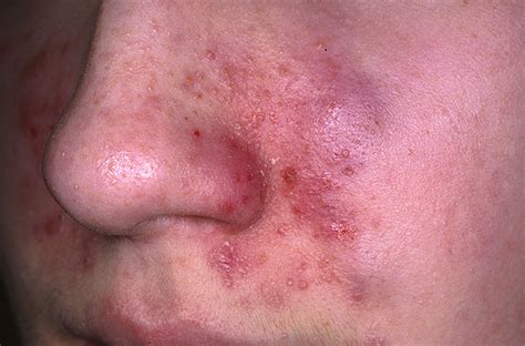 Seborrheic Dermatitis Pictures, Causes, Symptoms, Treatment and Cure