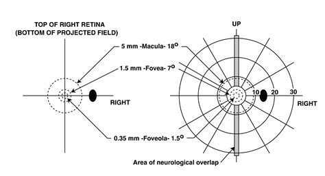 macular sparing - meddic