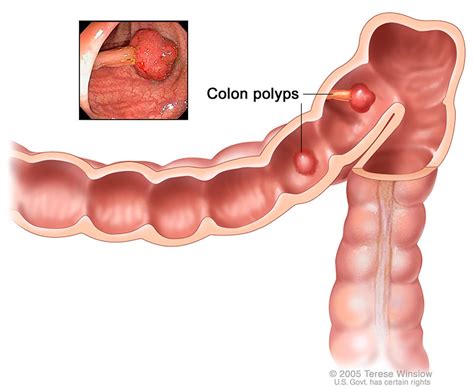 Staging and Evaluation - Colorectal Cancer - Siteman Cancer Center