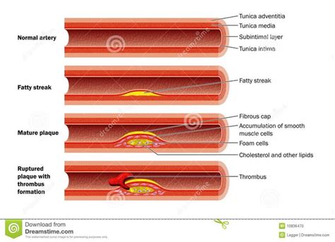 Plaque formation in artery. The development of an atheromatous plaque in the wal #Sponsored , # ...