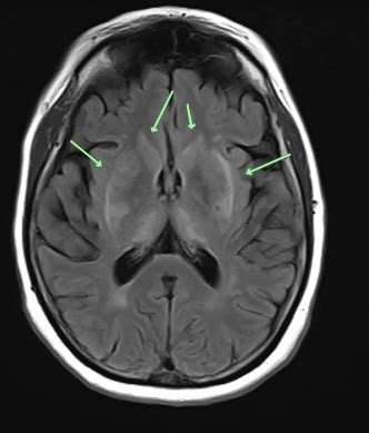 What are the Differential Diagnoses for Depression?