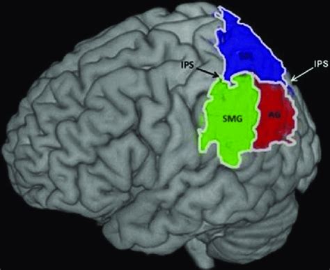 Superior Parietal Lobule Approach