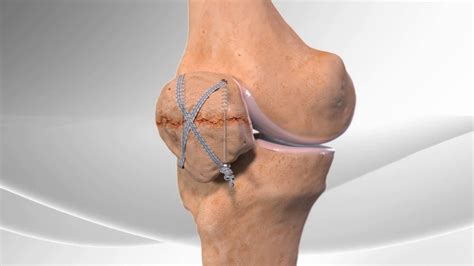 Patella Fracture Repair - YouTube