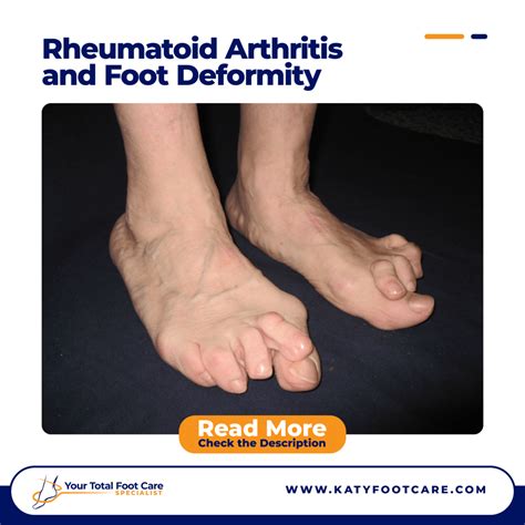 Rheumatoid Arthritis and Foot Deformity