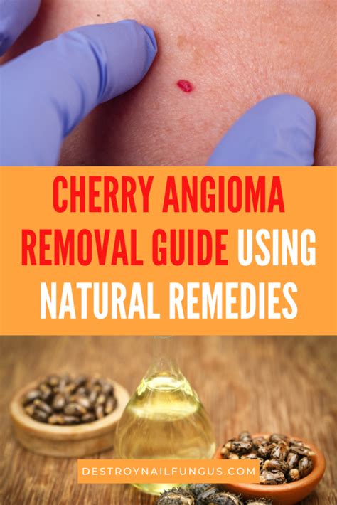 Cherry Angioma Removal: Apple Cider Vinegar And Other Home Remedies