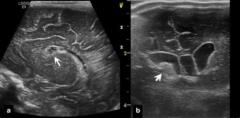 Germinal Matrix Hemorrhage Ultrasound