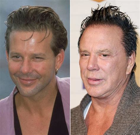 Mickey Rourke Plastic Surgery Face Before And After Photos