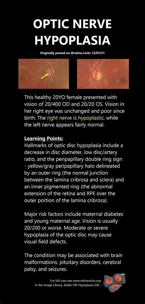 Optic Nerve Disorders > Optic Nerve Hypoplasia - Retina Rocks