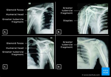 Dislocated shoulder: Causes, types, symptoms, diagnosis | Kenhub