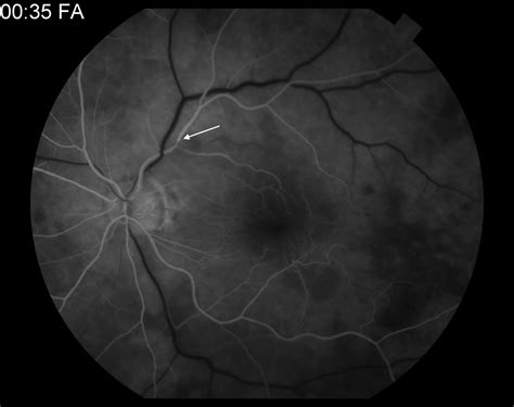 Moran CORE | Fundus Photography and Fluorescein Angiography of Branch Retinal Artery Occlusion