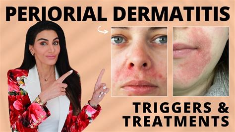 What Is Perioral Dermatitis? Symptoms, Causes, Diagnosis, pregnancy rash under breasts ...