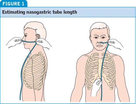 Figure 1 from Nasogastric tube insertion in adults who require enteral ...