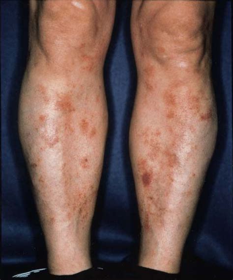 Chronic pigmented purpura associated with odontogenic infection - Journal of the American ...