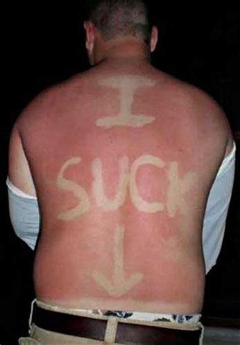 20 Times That The Sun Won The Battle Against SPF | Tan lines, Funny sunburn, Sunburn