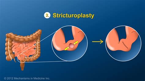 A stricturoplasty can relieve obstruction but does not remove any portion of the intestine. The ...