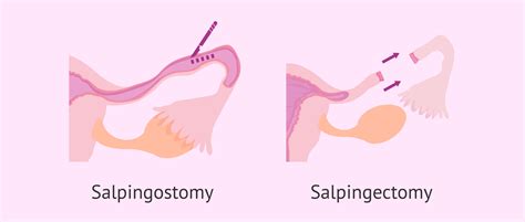 Salpingostomy and salpingectomy for treatment of ectopic pregnancy