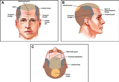 The Importance of Right Hairline Design in a Hair Transplant # ...