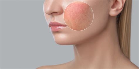 Facial Rash – 6 Common Causes, Symptoms and When to Seek Treatment – Dr. HM Liew Skin Clinic