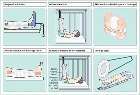 Types of Skin Traction - Medical Surgical