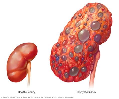 Chronic kidney disease - Symptoms and causes - Mayo Clinic