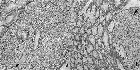 Two cases in which the signet ring cells have invaded the mucosa of the ...