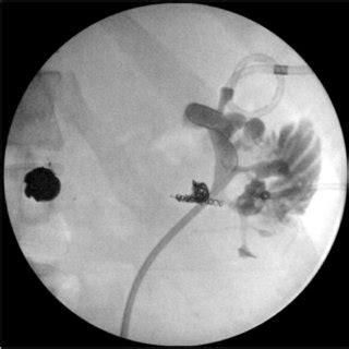 Left Retrograde Pyelogram with Fistula Left retrograde pyelogram ...