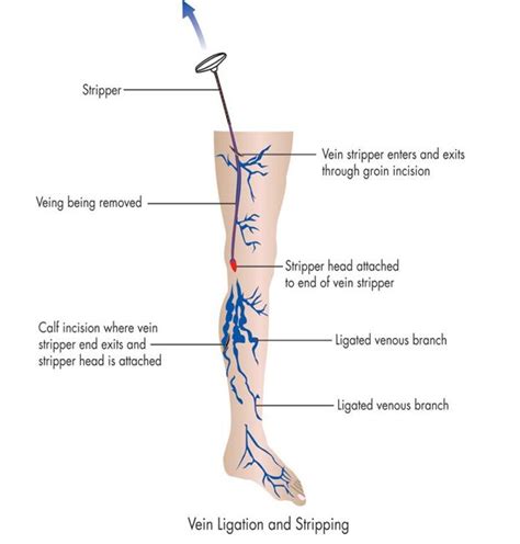 Varicose Vein Treatment Singapore | Options for Patients